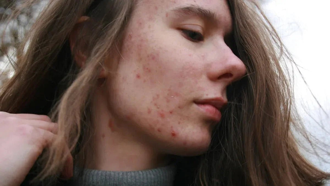 How to Identify and Manage Every Type of Acne - Bee Naturals