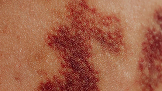 Understanding psoriasis dermatitis seborrhea - Bee Naturals