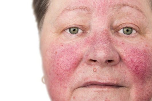 Understanding Rosacea: Symptoms, Triggers, and Treatment Options - Bee Naturals Store